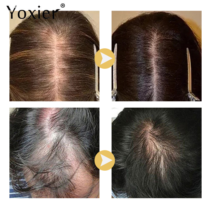 Intensive Growth Serum Prevent - огляд і ціна Hair Care Treatment